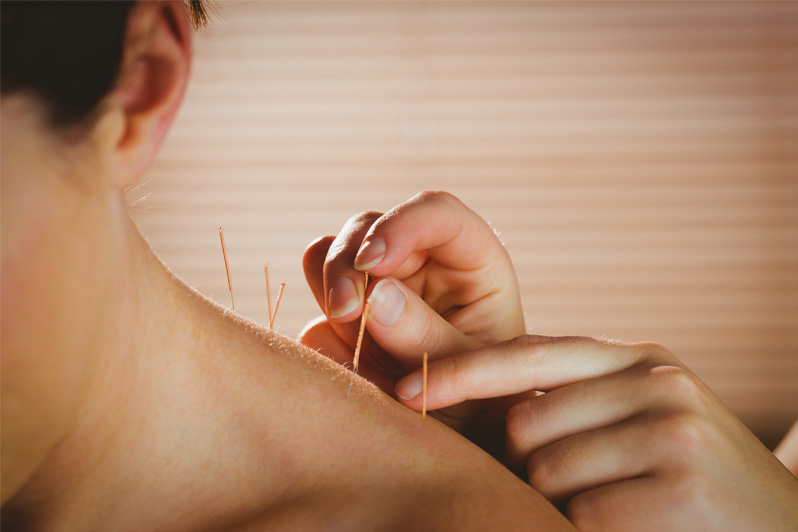 Woman getting acupuncture treatment on her shoulder