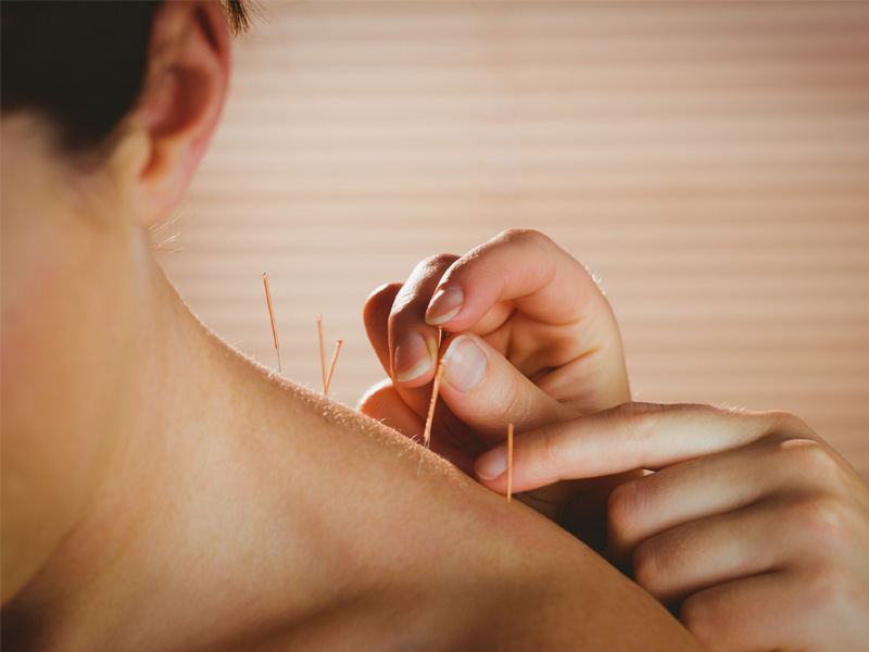 Patient getting acupuncture on their shoulder