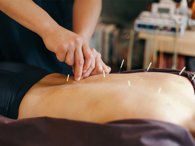 Patient getting acupuncture on their back