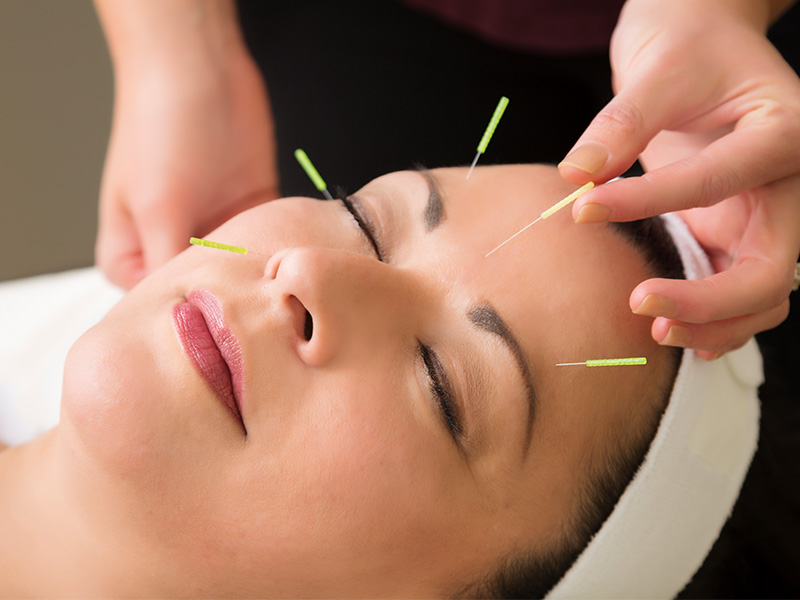 Woman getting acupuncture facial